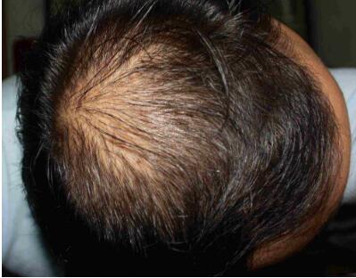 哪些习惯容易导致脱发 导致脱发的原因居然是这四个