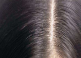 白发是什么原因造成的 分析常见的六大原因