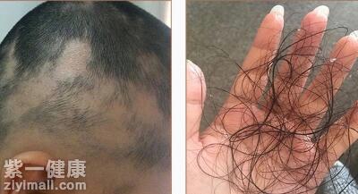 掉头发怎么办 三种调理方法可有效缓解掉发