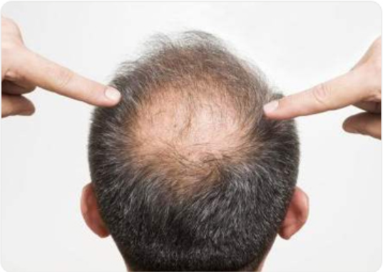 脂溢性脱发是怎么形成的 盘点脂溢性脱发的5个原因