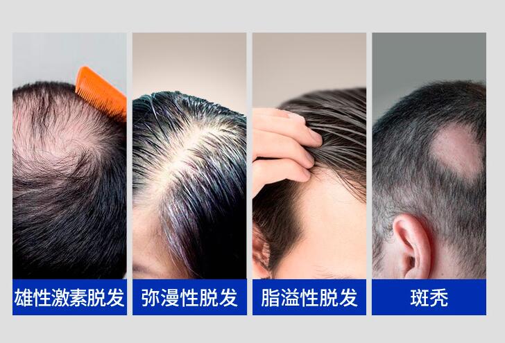 为什么会脱发 详解脱发的四大原因