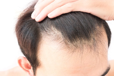 怎么才能不掉头发 防止脱发的四步骤