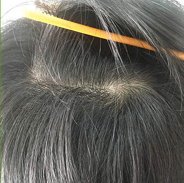 白头发多是什么原因 白头发多如何改善