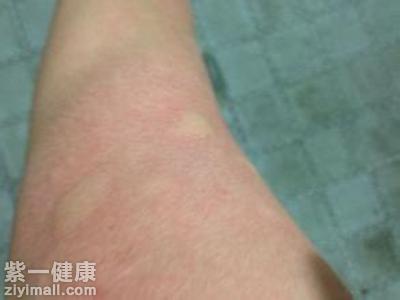 皮肤过敏瘙痒怎么办 治疗皮肤过敏先要了解过敏原