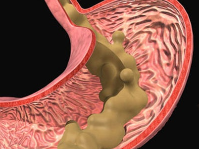 反胃酸怎么办 饮食调节胜过药物
