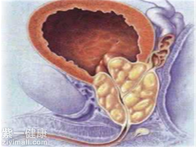 老年人膀胱结石怎么办 中医食疗来帮你