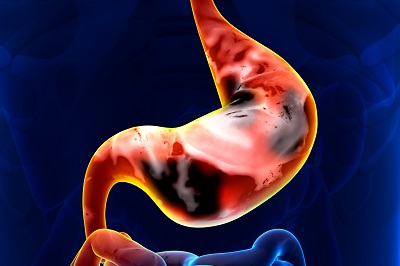 胃癌晚上睡觉4个症状 一旦出现就要引起重视