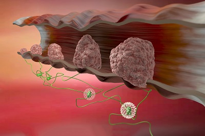 肠癌三多一痒 详解肠癌的两大表现