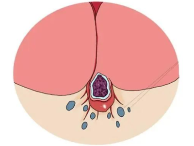 痔疮肉球1度2度3度图片 痔疮肉球1度2度3度症状